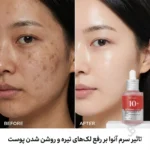 تاثیر سرم آنوا بر رفع لک‌های تیره و روشن شدن پوست